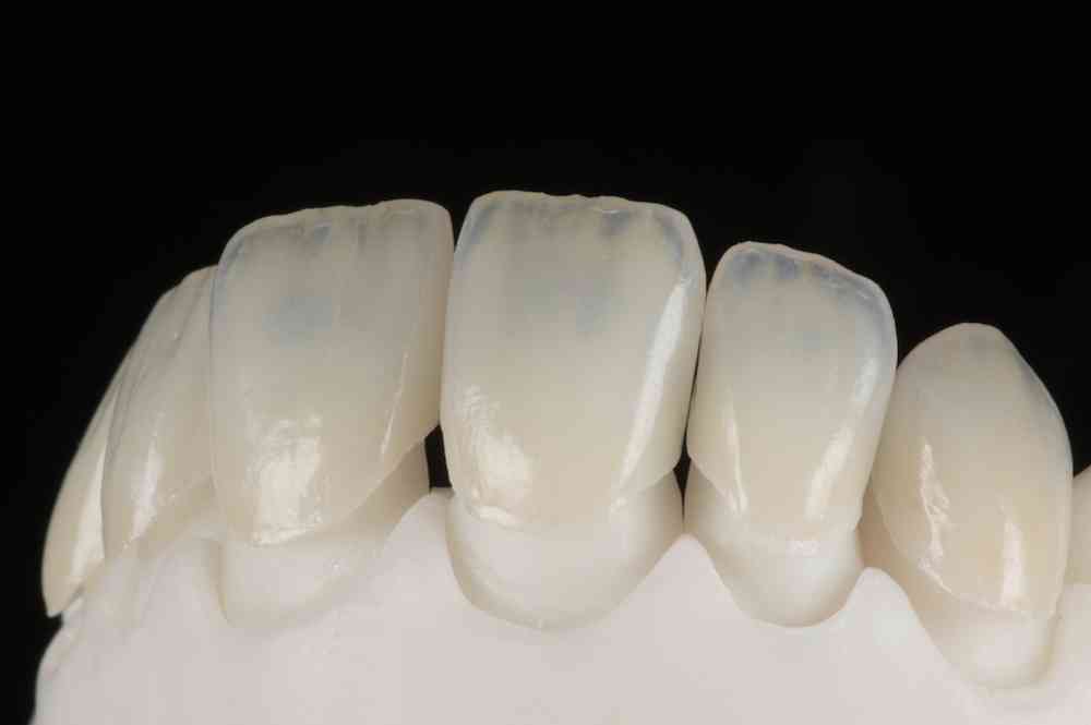 Carillas Dentales de Porcelana E-max